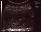 Katherine's first scan