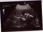 Katherine's second scan